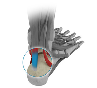 Reconstruction du tendon d'Achille