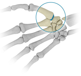 Arthroplasty of the thumb