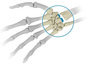Arthroplasty, osteotomy or arthrodesis of the wrist