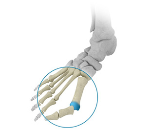 Clinique chirurgicale de Laval Cheville Pied Arthroplastie