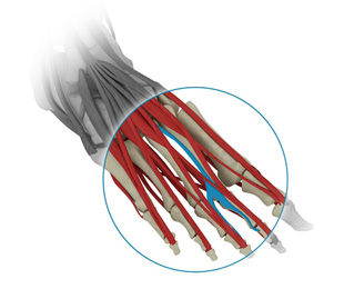 Clinique Chirurgicale de Laval Ankle Foot Morton s neuroma